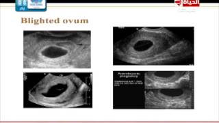 العيادة - د.إسماعيل أبو الفتوح - بالصور كيف يحدث الإجهاض والنزيف - The Clinic