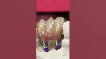 Signature Ceramics with Mini Syton Hybrid Implants