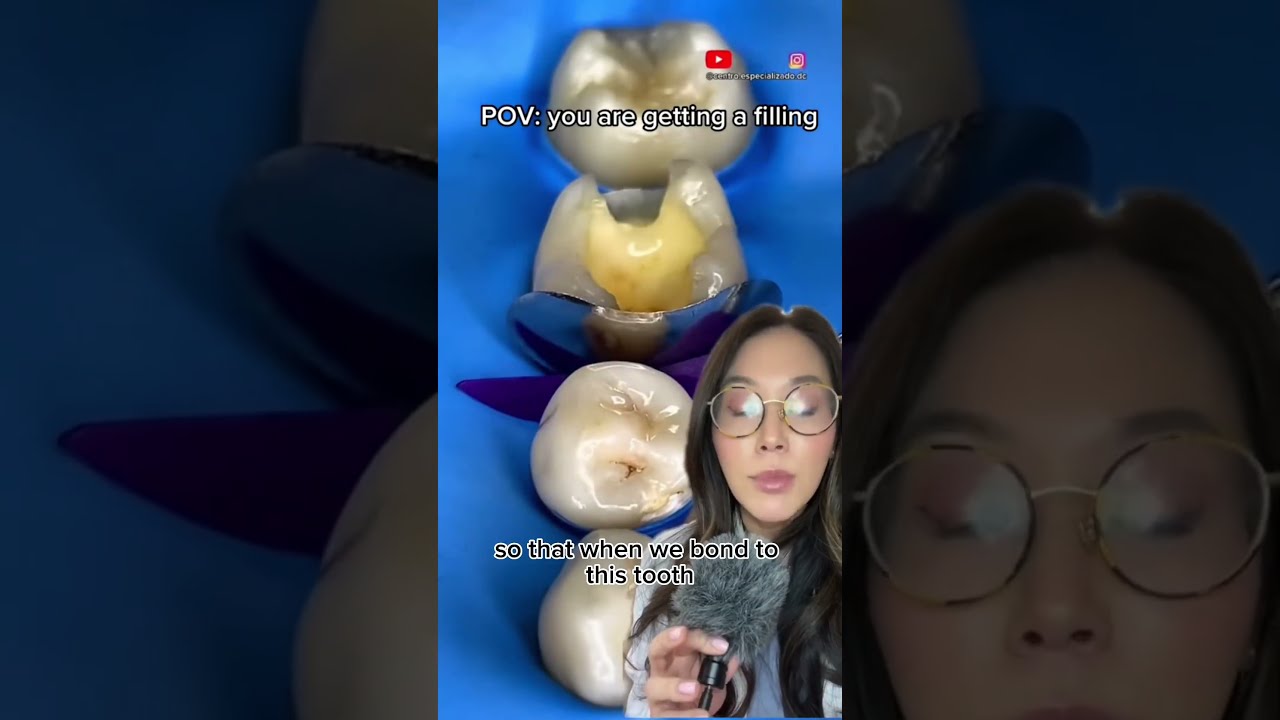 When Fixing A Cavity Here S How We Make Sure Your Teeth Don T Stick Together Filling