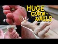 MASSIVE CORN AND NAILS!! SUPER Satisfying Corn removal and nails