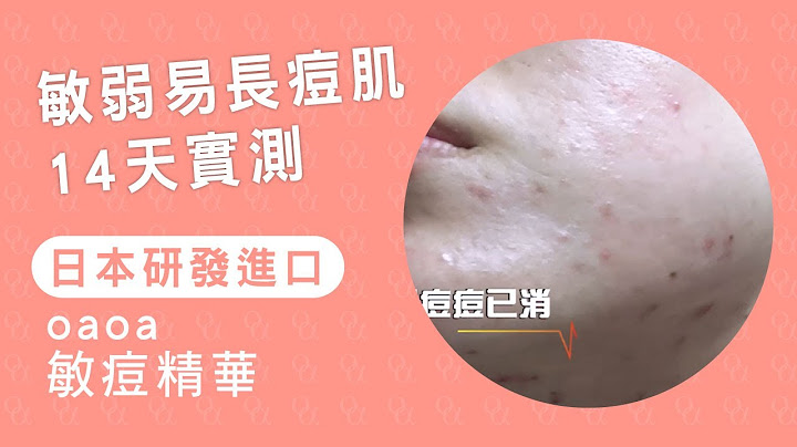 【實測】敏弱痘痘肌14天真實心得 | oaoa敏痘精華 - 天天要聞