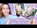 ROACCUTAN o ACCUTANE: Efectos adversos, como tomarla, antes y despues. LA VERDAD de la ISOTRETINOINA