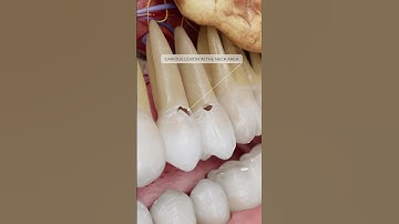 What are Class V dental caries and why do they require attention? Explore dentistry in 3D with VOKA!