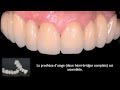 Bridge dentaire céramique complet remplaçant toutes les dents