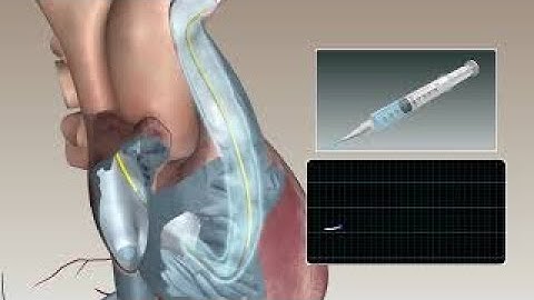 Swan Ganz catheter bolus thermodilution animation