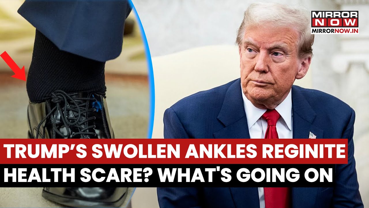 Donald Trump’s Hand Bruises And Swollen Ankles: What Do Experts Say About His Health? Watch