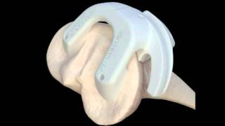 Custom Fit Knee Replacement