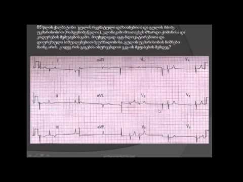 ეკგ. ჰიპერკალიემია. გულის რევმატული დაზიანება. hiperkaliemia. gulis revmatuli dazianeba. revmatizmi.