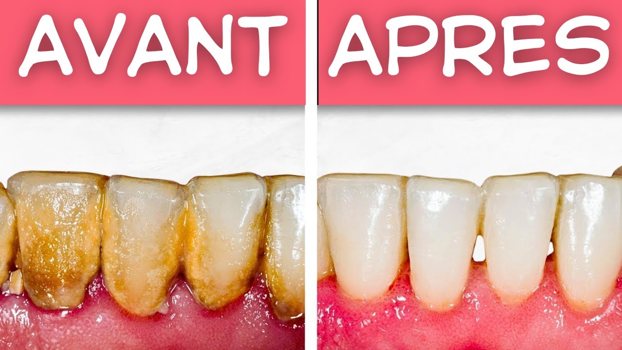 Le Secret d'un Sourire Sain : Stratégies Naturelles pour Combattre la Plaque Dentaire