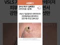 검버섯 제거? 실패했던 2가지 이유