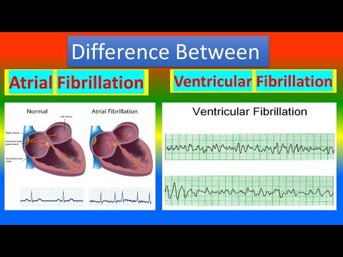 Video: Was ist schlimmer afib oder vfib?