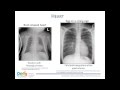 Approach to Pediatric Chest X-Rays