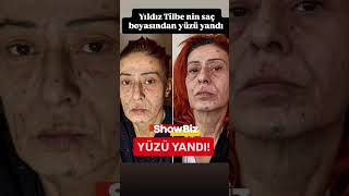 Yıldız Tilbe Nin Yüzü Yandı Resimi