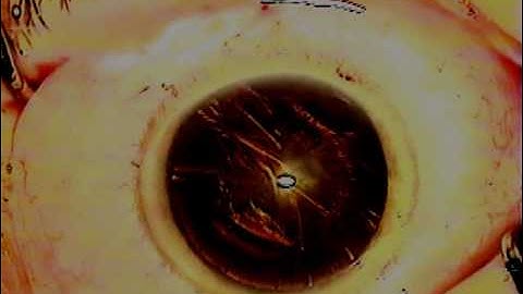 Mom's Cataract Eye Surgery