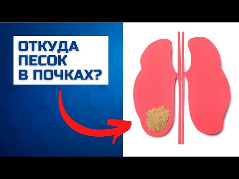 Песок в почках | Песок в моче при мочекаменной болезни