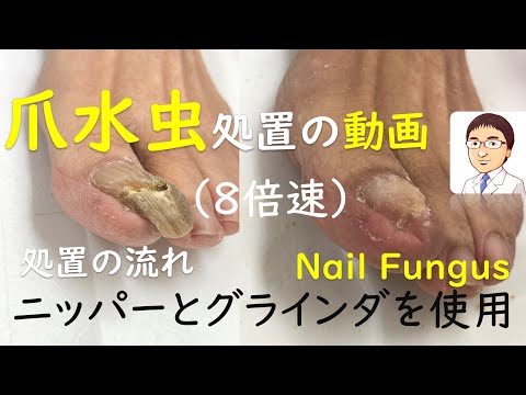 水虫 処置 ガーゼ 水虫 処置 ガーゼ
