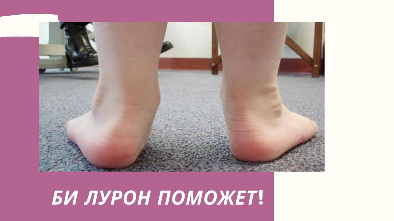 Эквинусная установка стоп. Эквинусная установка стопы. Эквинусная установка стопы. Эквинусная деформация стопы рентген. Эквинусная деформация рентген.