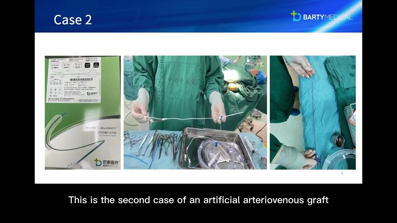 Application of Ultra Wanty Balloon Catheter in Arteriovenous Fistula