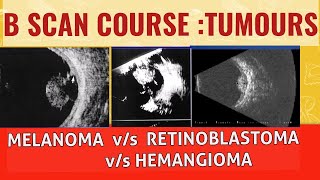 Bscan course || Differentiating choroidal melanoma from retinoblastoma and choroidal hemangioma
