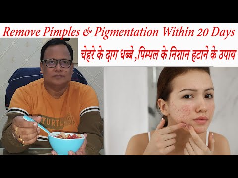 Remove Pimples & Pigmentation Within 20 days / चेहरे के दाग धब्बे ,पिम्पल के निशान हटाने के उपाय ||