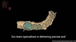 Exocad : Post and Crown Design for Dental Lab