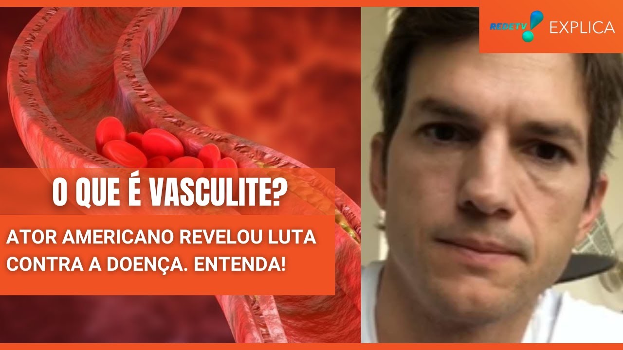 Vasculite Entenda A Doen A Que Deixou Ashton Kutcher Sem Ouvir Ver E Andar Redetv Explica