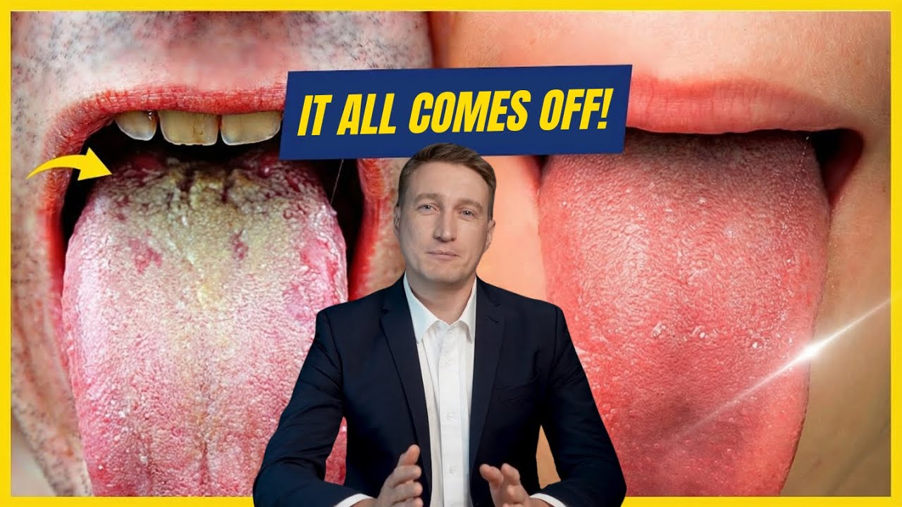 GET RID OF White Tongue in Just 1 Minute a Day! (Proven)