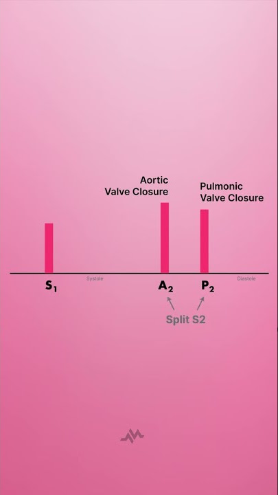 Split S2 Heart Sound - Shorts