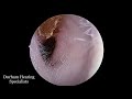 Extremely compact dead skin removal from ear canal (extracted with an endoscope)
