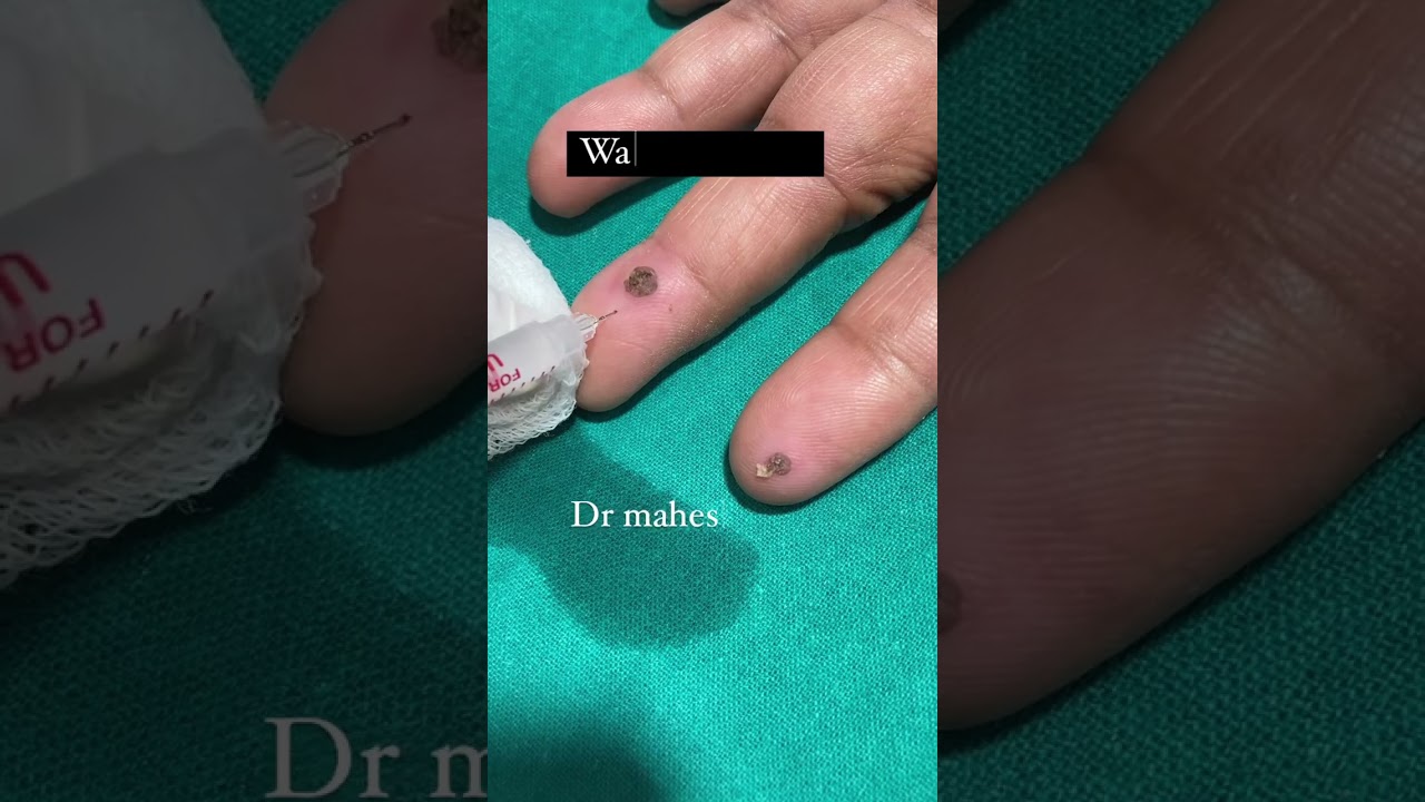 Warts removal/warts/laser treatment/laser/dermatologist Surat/skin care/co2laser