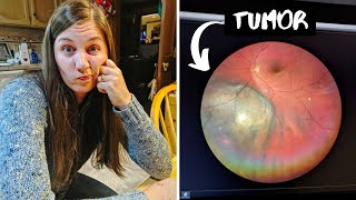 I Have Cancer | My Ocular Melanoma Story Part 1