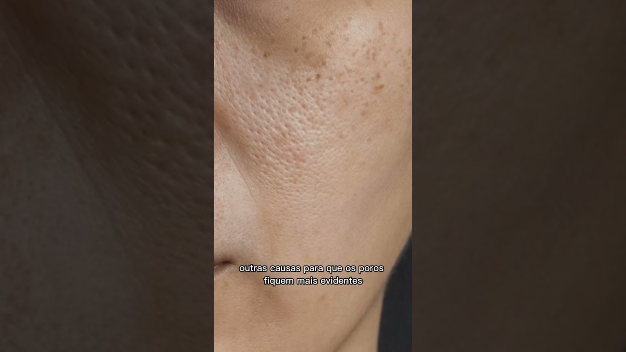 Como diminuir os poros dilatados 