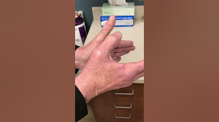 extensor pollicis longus tendon rupture #shorts