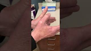 extensor pollicis longus tendon rupture #shorts