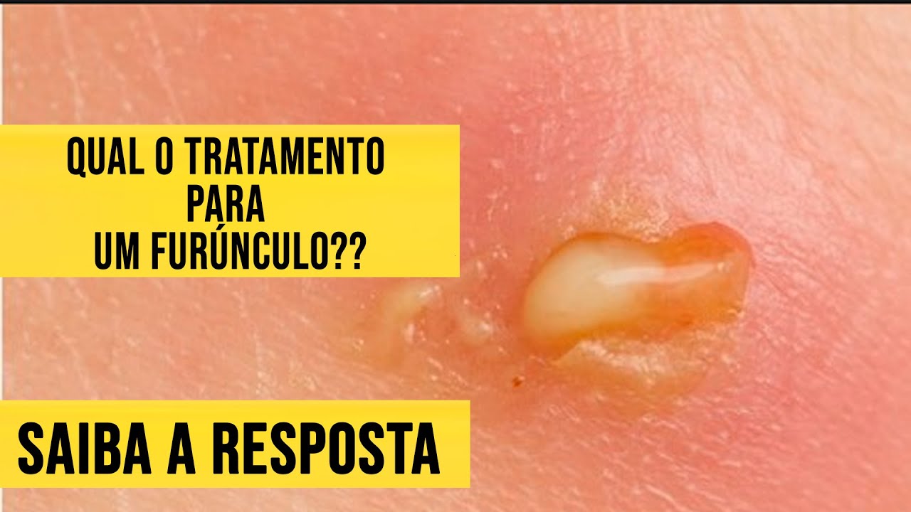Qual o tratamento para um furúnculo ? - YouTube