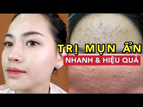 TRỊ MỤN ẨN, MỤN ĐẦU ĐEN, DA SẦN SÙI NHANH VÀ HIỆU QUẢ !!! DA TRƠN LÁNG CHỈ SAU 2 THÁNG !!!