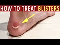 How to Treat Blisters |  Home remedies of blister treatment and heal