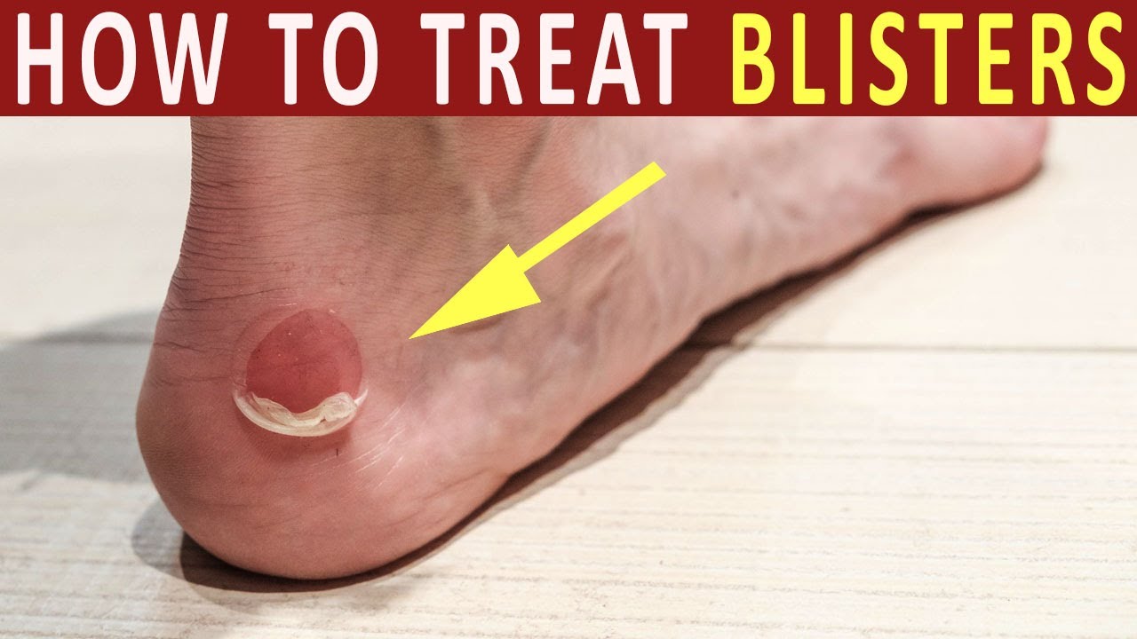 blister treatment