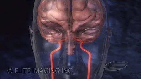 Brain Clot Removal - Medical & Scientific Video Production