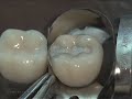 Class II Amalgam Preparation & Restoration | Operative Dentistry