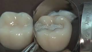 Class II Amalgam Preparation & Restoration | Operative Dentistry