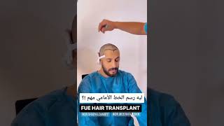 ليه رسم الخط الأمامي مهم في زراعة الشعر shortsvideo