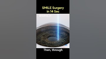 SMILE Surgery in 14 Sec