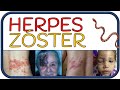 HERPES ZÓSTER - culebrilla, síntomas, herpes zóster oftálmico, Sx Ramsey-Hunt y complicaciones