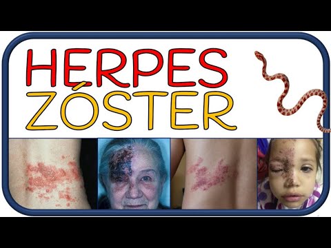 Video: ¿Por qué el herpes zoster es unilateral?