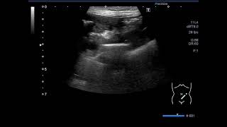 魚の骨をたべました。魚の骨???小腸内の高輝度エコー像