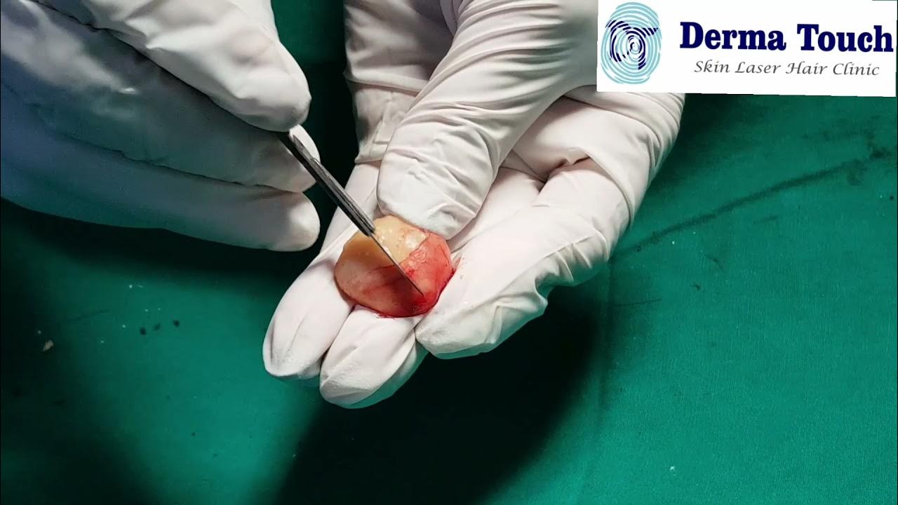cutting-open-sebaceous-cyst-from-scalp-youtube