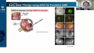 Lecture: Gene Therapy for AMD: Are We There Yet