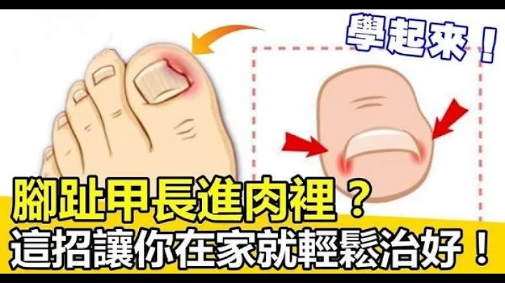 腳趾甲長進肉裡？不用拔甲，1招讓你在家就輕鬆治好！！ - 天天要聞
