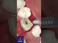 Dentistry Implant Surgery 
